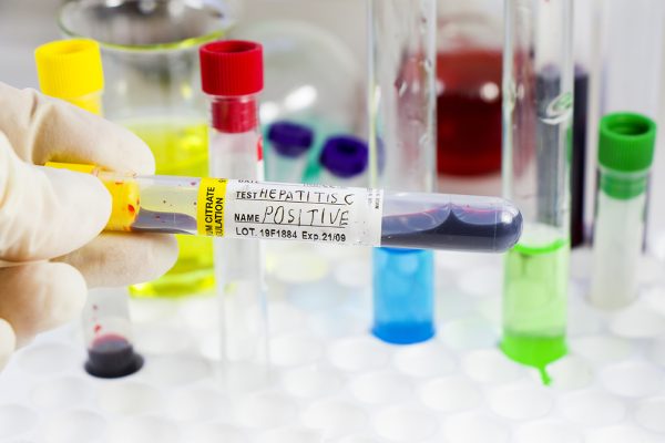 A closeup shot of a doctor's hand holding a positive Hepatitis C virus blood test full tube with other laboratory items in the background